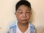 竹市运动场踢足球 学童被蜜蜂叮成麵包超人 - 中时电子报