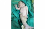 印度妇人產下「美人鱼宝宝」 出生4小时夭折 - 中时电子报
