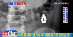 影》童吞8颗磁力球不敢讲 肠穿孔险引败血症 - 中时电子报